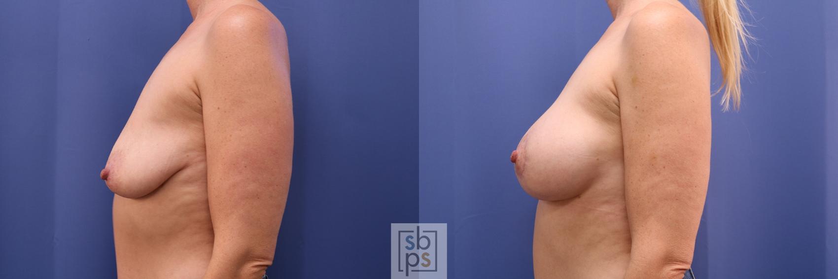 Before & After Breast Lift Case 383 Left Side View in Torrance & Los Angeles, CA, CA