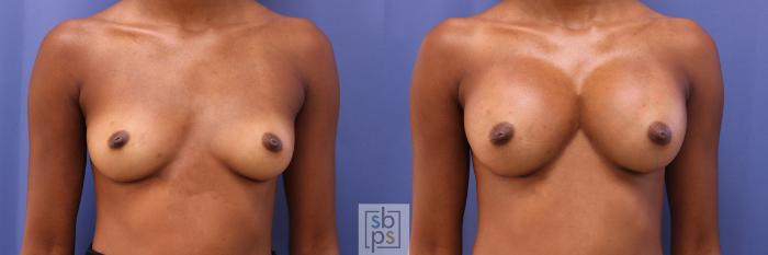 Before & After Breast Augmentation Case 390 Front View in Torrance, CA