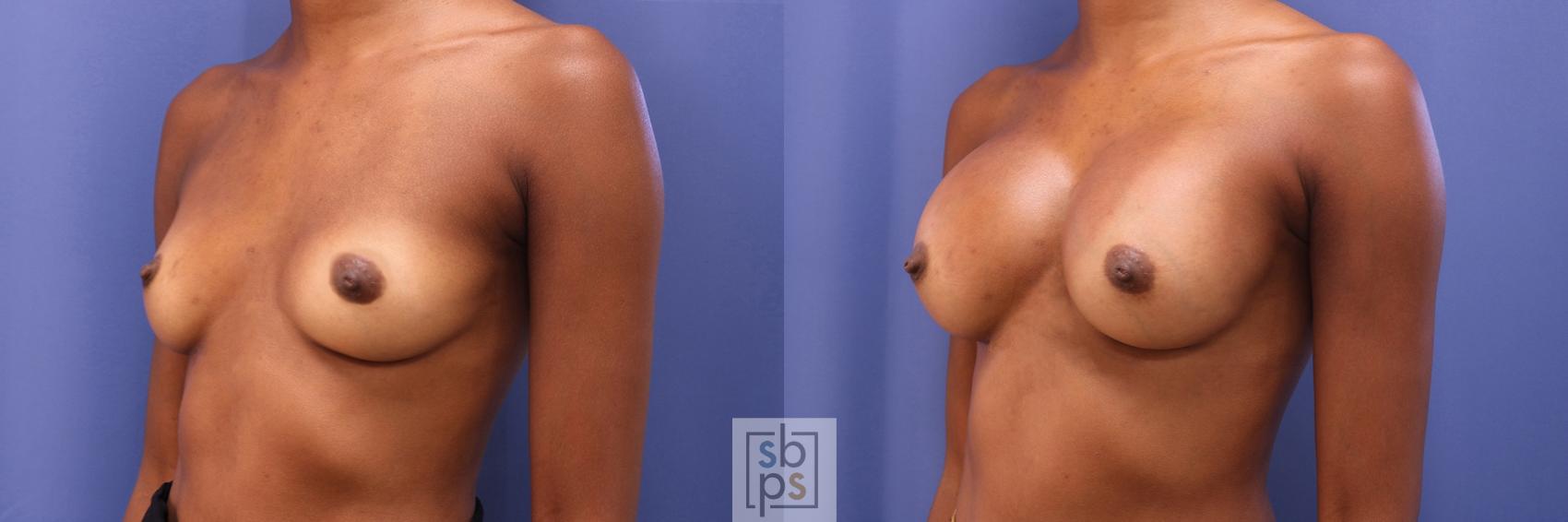 Before & After Breast Augmentation Case 390 Left Oblique View in Torrance & Los Angeles, CA, CA
