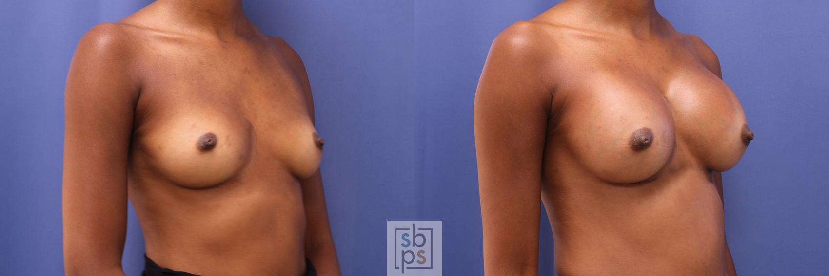 Before & After Breast Augmentation Case 390 Right Oblique View in Torrance & Los Angeles, CA, CA