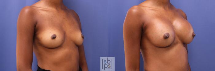 Before & After Breast Augmentation Case 390 Right Oblique View in Torrance, CA
