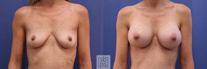 Before & After Breast Augmentation Case 401 Front View in Torrance, CA