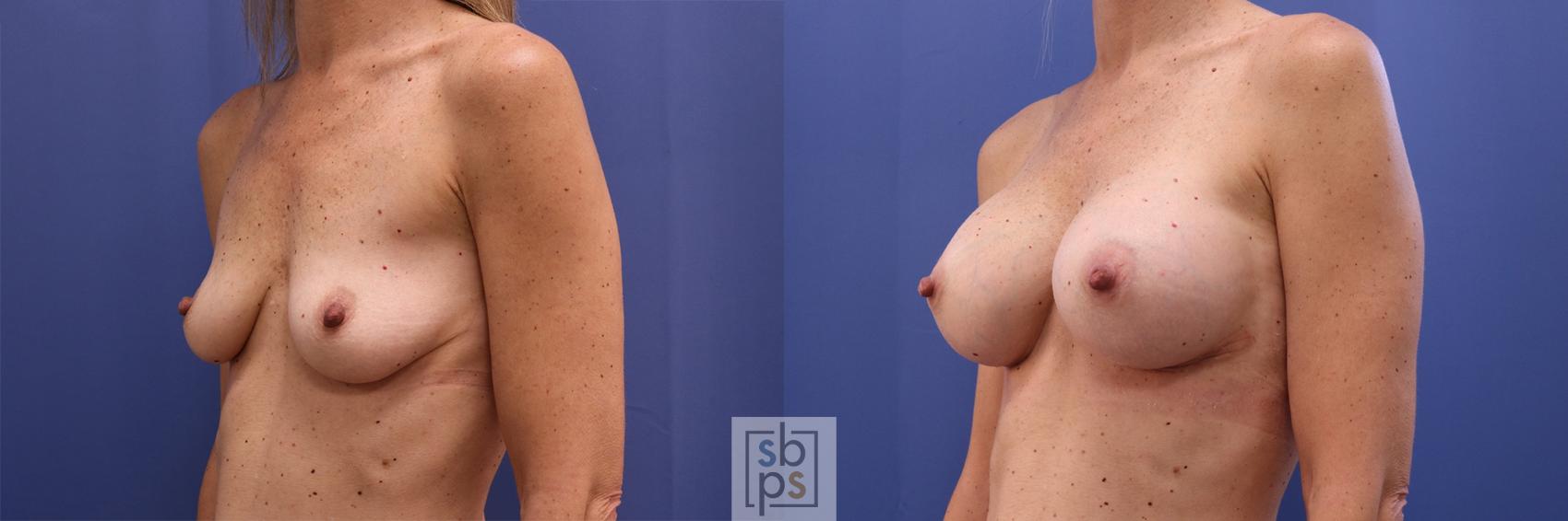 Before & After Breast Augmentation Case 401 Left Oblique View in Los Angeles & Torrance, CA, CA