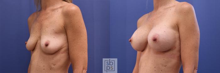 Before & After Breast Augmentation Case 401 Left Oblique View in Torrance, CA