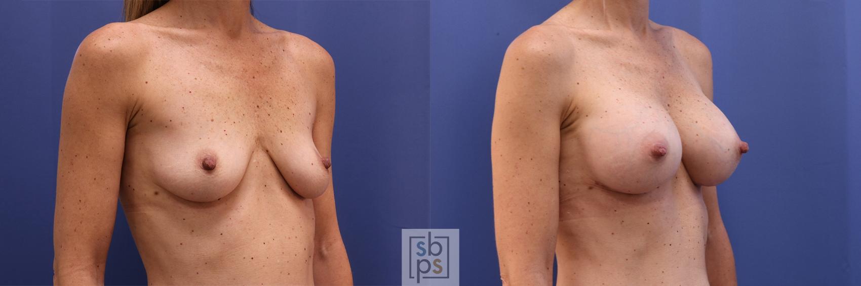Before & After Breast Augmentation Case 401 Right Oblique View in Torrance & Los Angeles, CA, CA