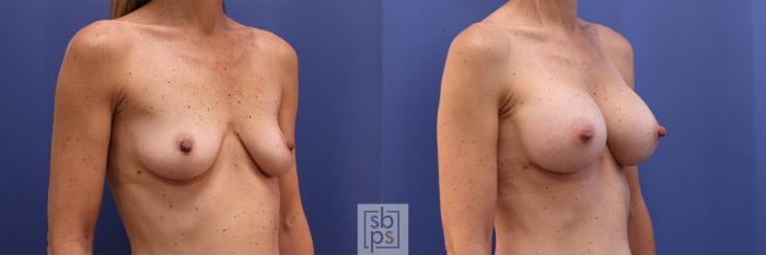 Before & After Breast Augmentation Case 401 Right Oblique View in Torrance, CA