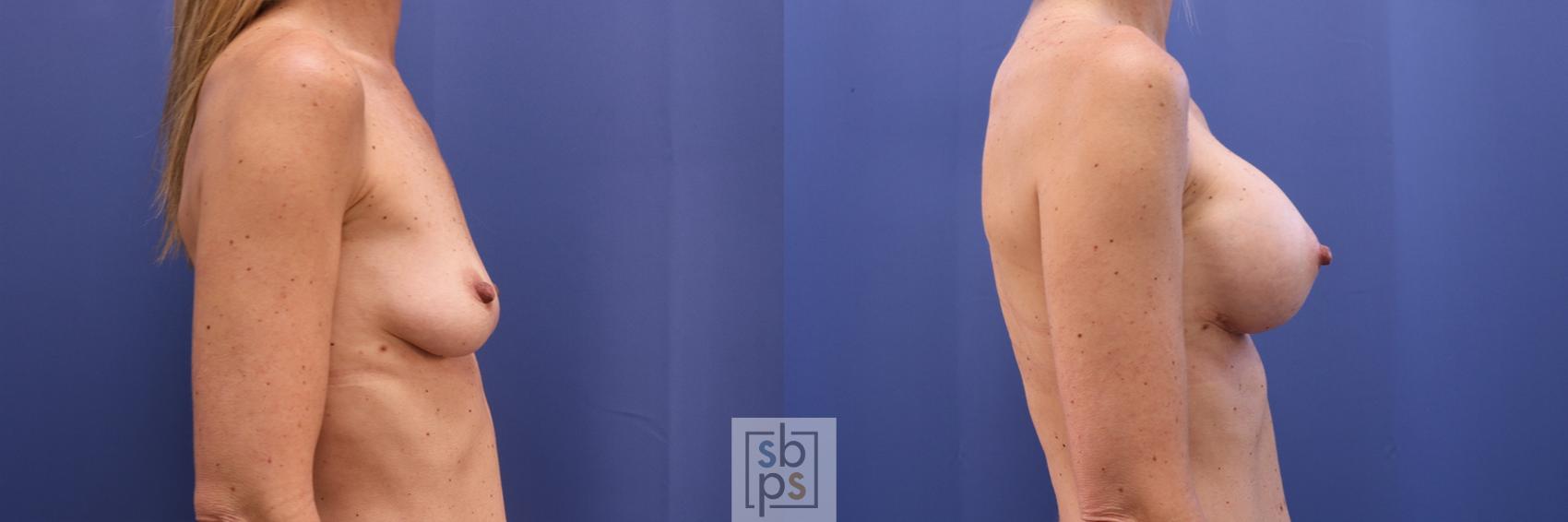 Before & After Breast Augmentation Case 401 Right Side View in Torrance & Los Angeles, CA, CA