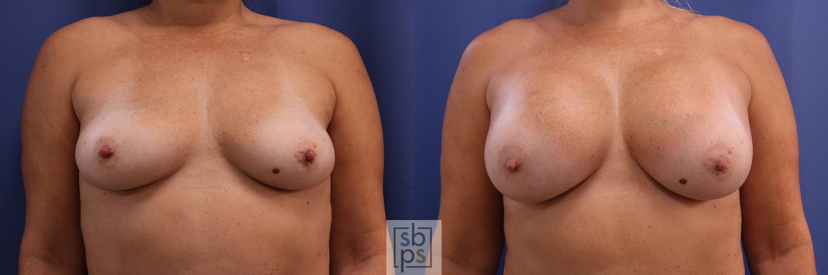 Before & After Breast Augmentation Case 404 Front View in Torrance, CA