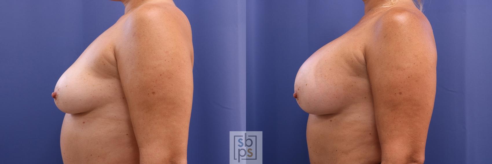 Before & After Breast Augmentation Case 404 Left Side View in Torrance & Los Angeles, CA, CA