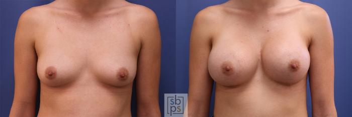 Before & After Breast Augmentation Case 406 Front View in Torrance, CA