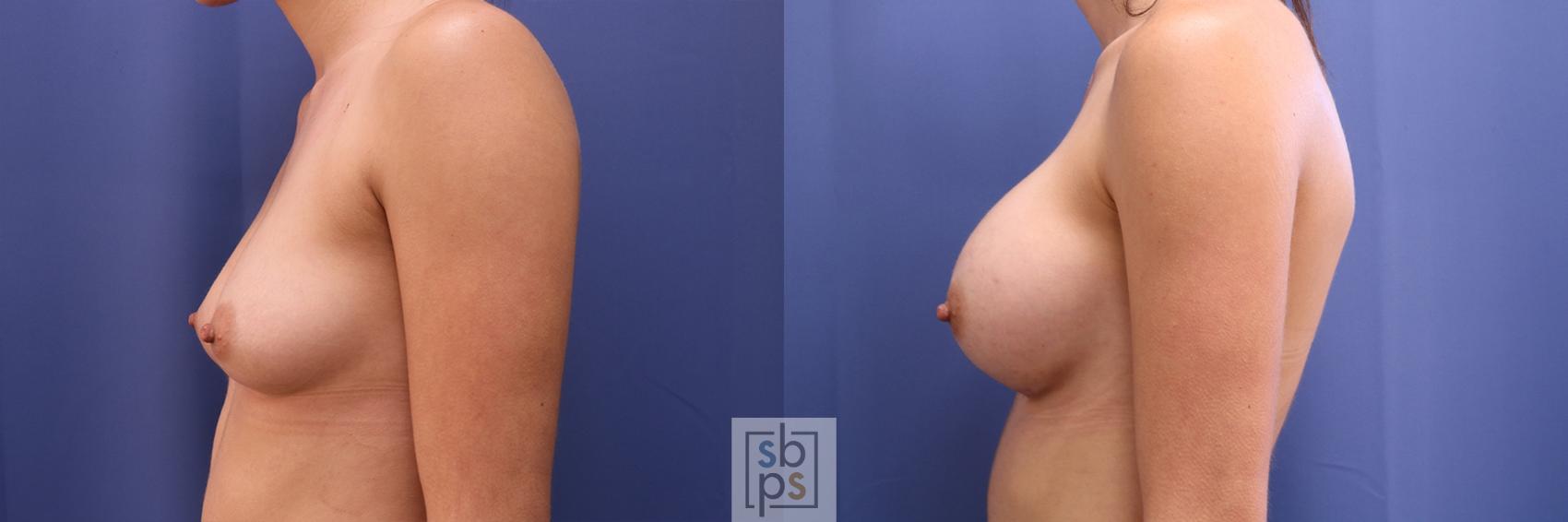 Before & After Breast Augmentation Case 406 Left Side View in Torrance & Los Angeles, CA, CA