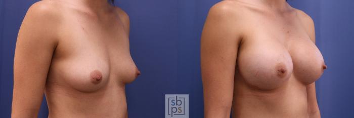 Before & After Breast Augmentation Case 406 Right Oblique View in Torrance, CA