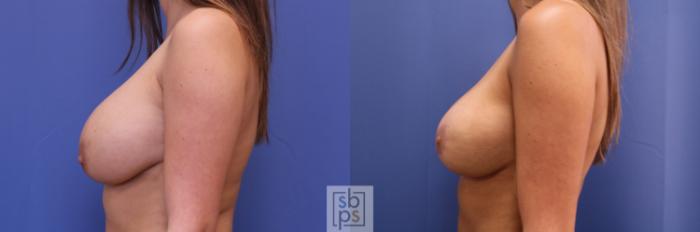 Before & After Breast Augmentation Case 409 Left Side View in Los Angeles & Torrance, CA, CA