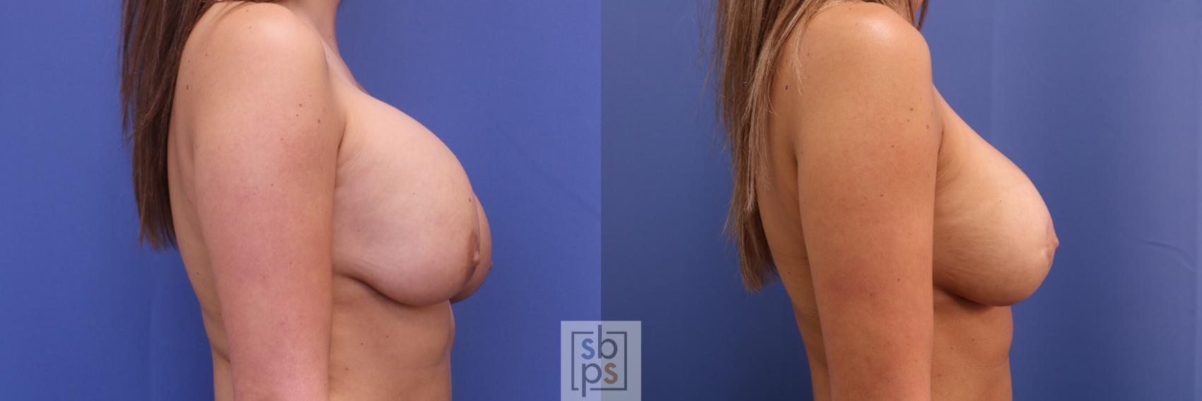 Before & After Breast Augmentation Case 409 Right Side View in Torrance & Los Angeles, CA, CA