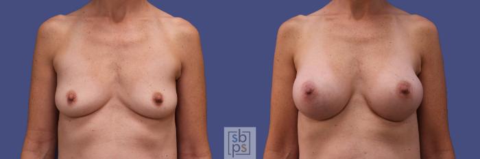 Before & After Breast Augmentation Case 420 Front View in Torrance, CA