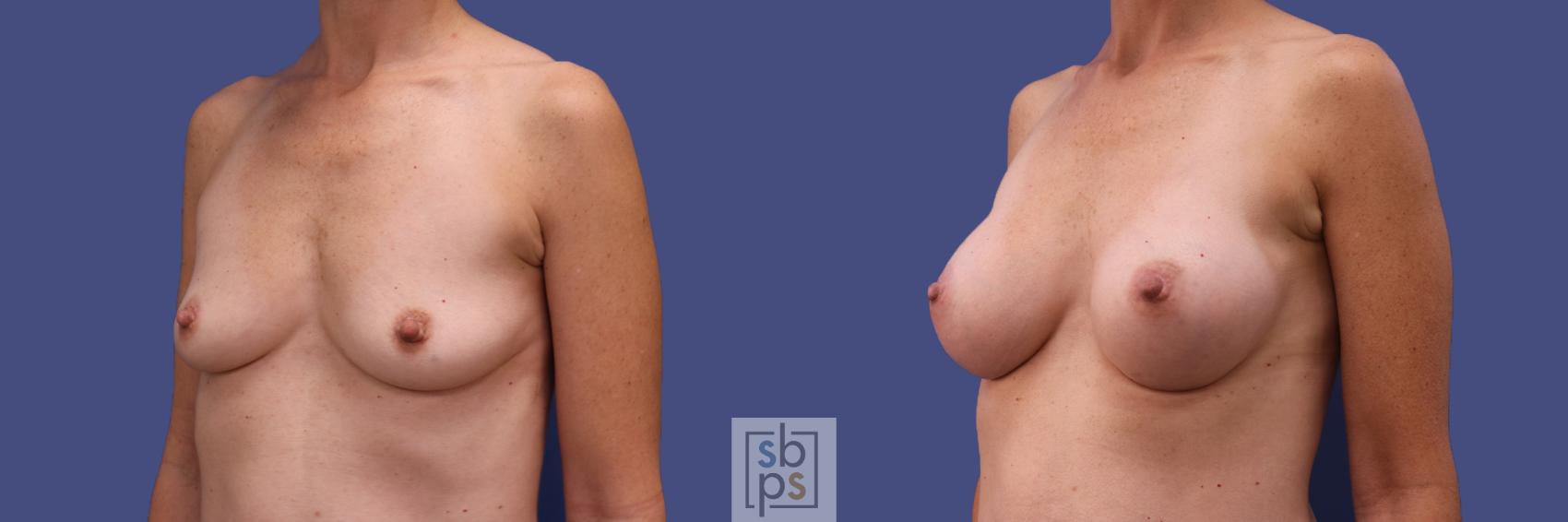 Before & After Breast Augmentation Case 420 Left Oblique View in Los Angeles, Torrance & Long Beach, CA