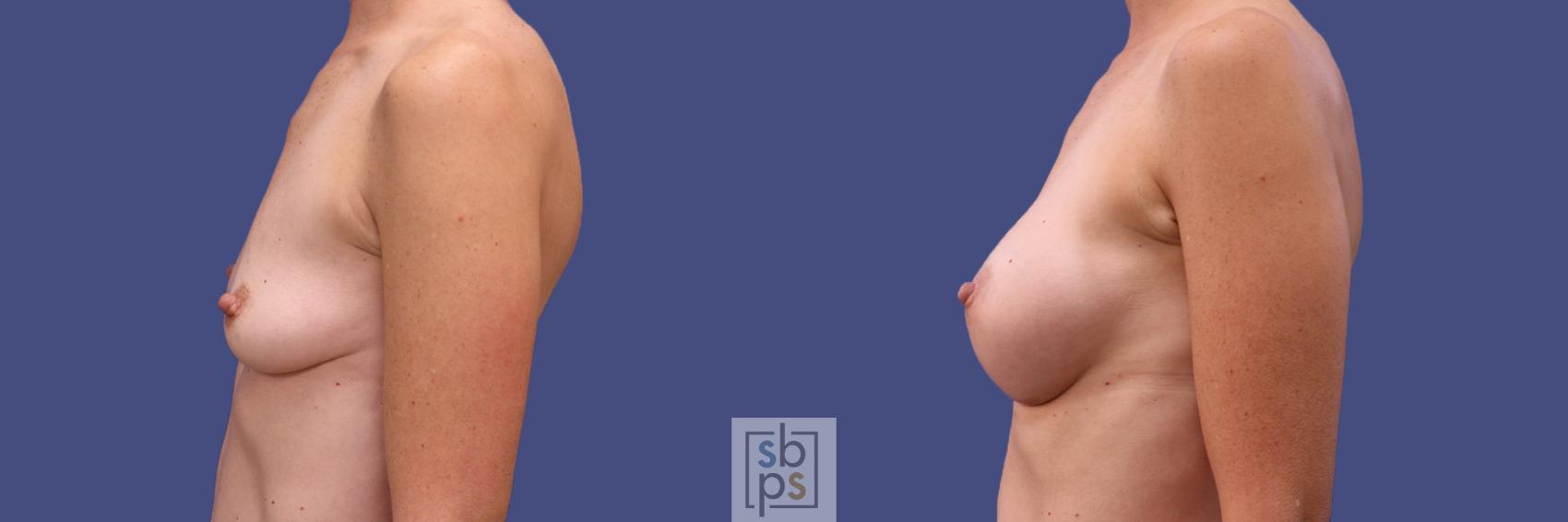 Before & After Breast Augmentation Case 420 Left Side View in Los Angeles, Torrance & Long Beach, CA
