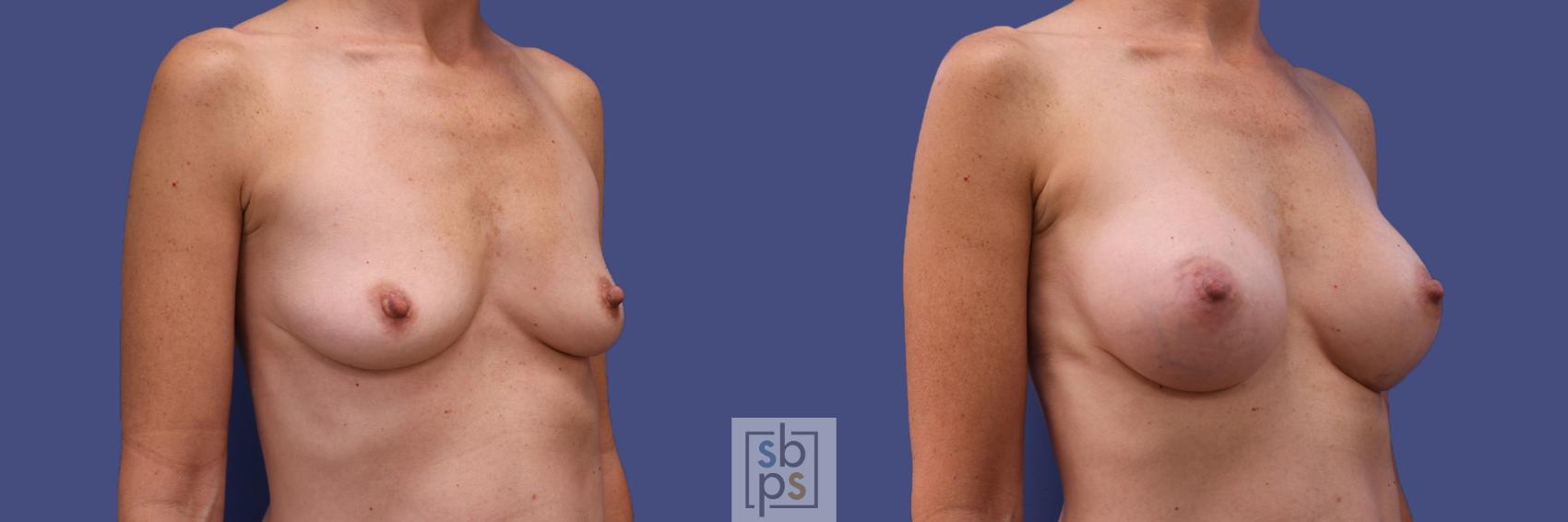 Before & After Breast Augmentation Case 420 Right Oblique View in Los Angeles, Torrance & Long Beach, CA