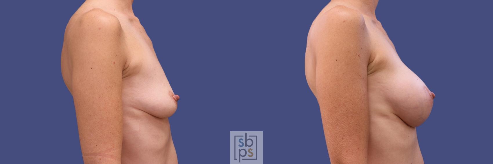 Before & After Breast Augmentation Case 420 Right Side View in Los Angeles, Torrance & Long Beach, CA