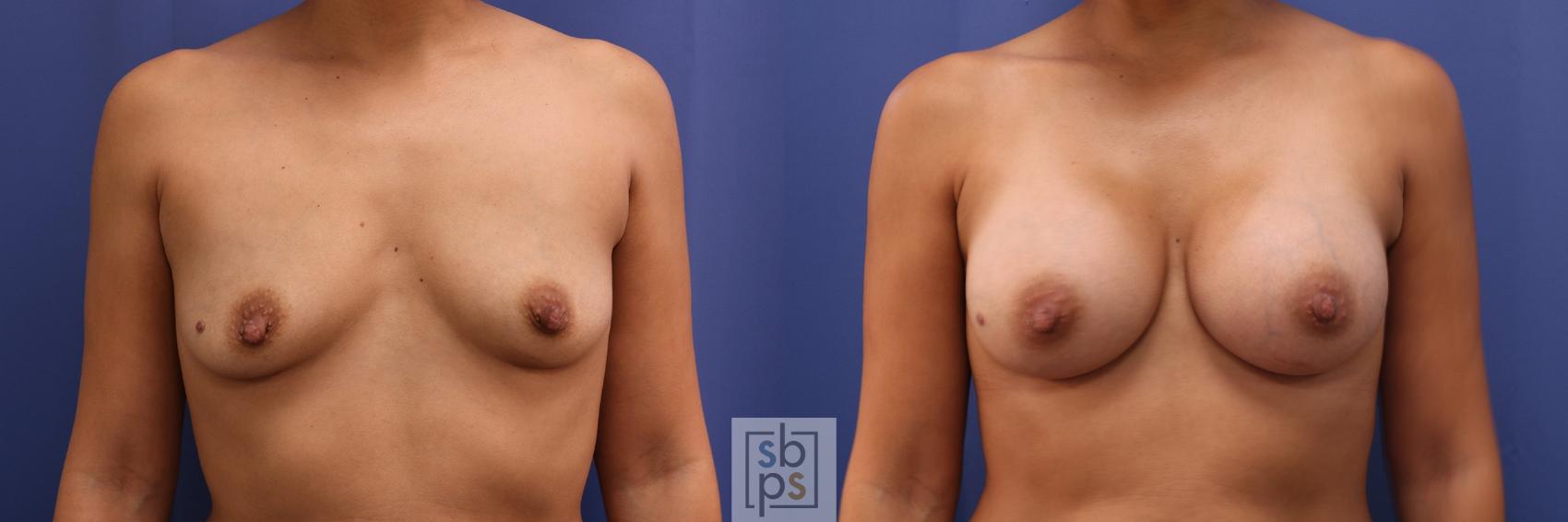 Before & After Breast Augmentation Case 435 Front View in Torrance, CA