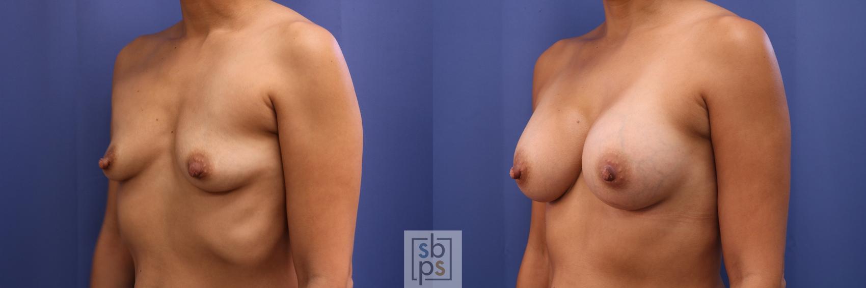 Before & After Breast Augmentation Case 435 Left Oblique View in Torrance & Los Angeles, CA, CA