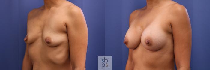 Before & After Breast Augmentation Case 435 Left Oblique View in Torrance, CA