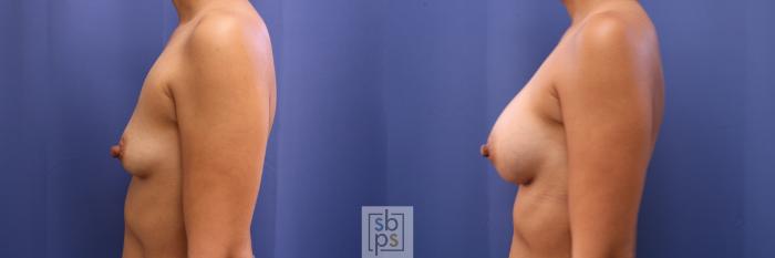 Before & After Breast Augmentation Case 435 Left Side View in Torrance, CA