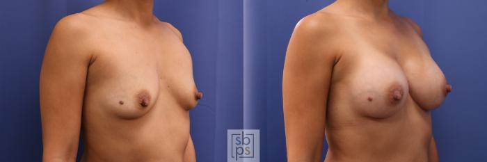Before & After Breast Augmentation Case 435 Right Oblique View in Torrance, CA