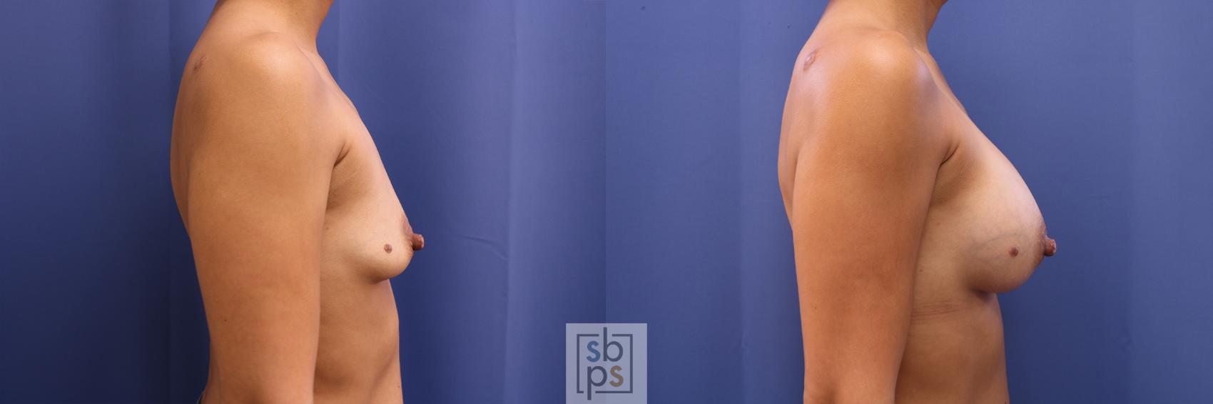 Before & After Breast Augmentation Case 435 Right Side View in Torrance & Los Angeles, CA, CA