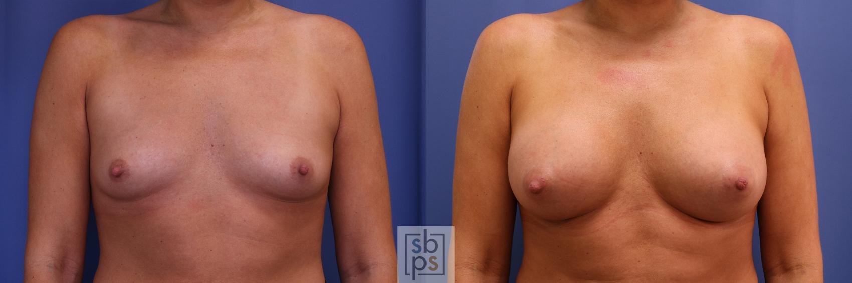 Before & After Breast Augmentation Case 439 Front View in Torrance, CA