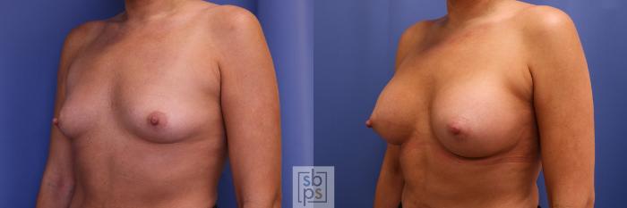Before & After Breast Augmentation Case 439 Left Oblique View in Torrance, CA