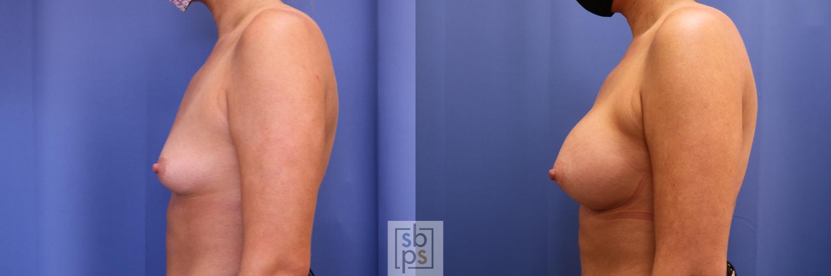 Before & After Breast Augmentation Case 439 Left Side View in Torrance & Los Angeles, CA, CA