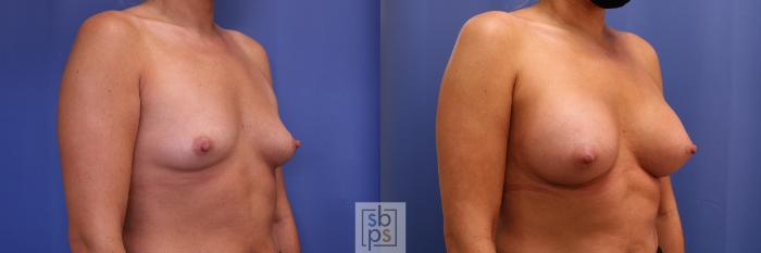 Before & After Breast Augmentation Case 439 Right Oblique View in Torrance, CA