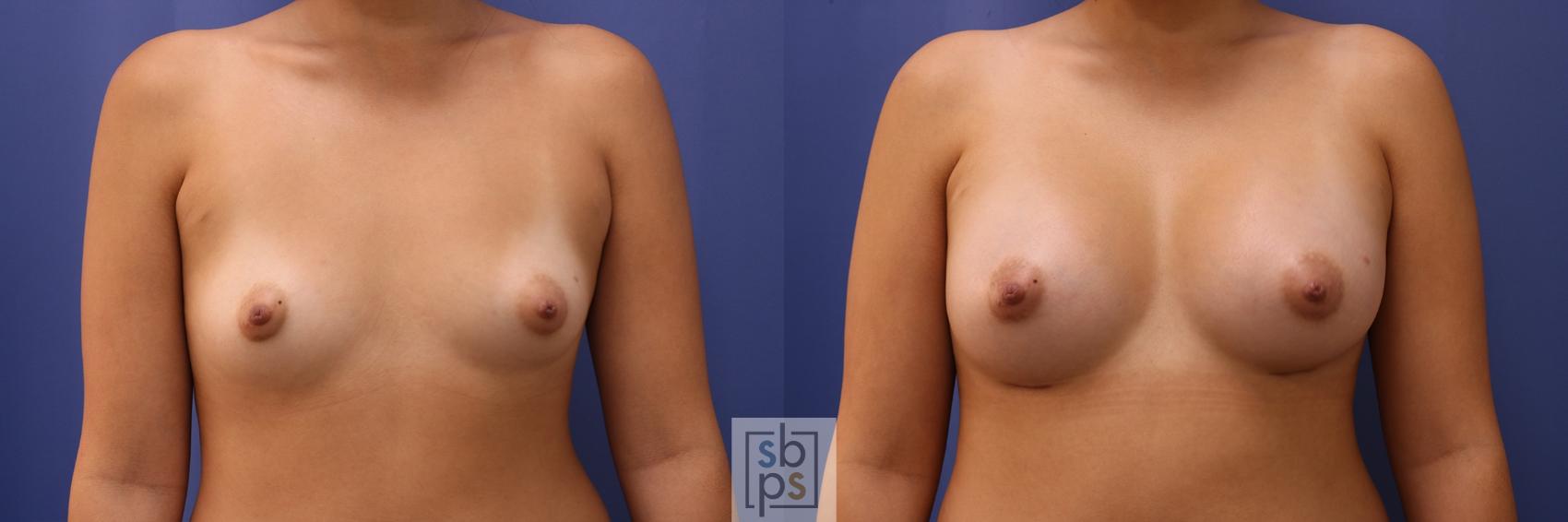Before & After Breast Augmentation Case 440 Front View in Torrance, CA
