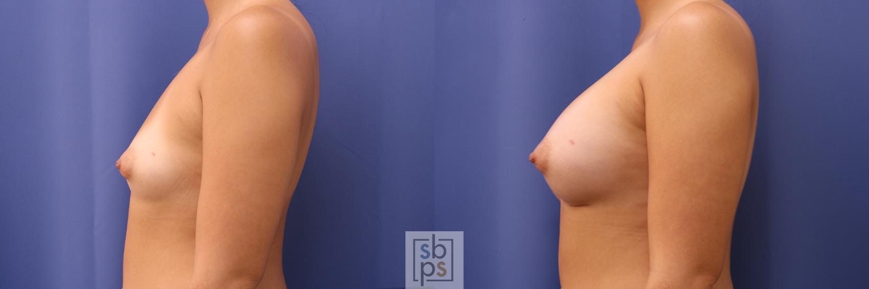 Before & After Breast Augmentation Case 440 Left Side View in Torrance & Los Angeles, CA, CA