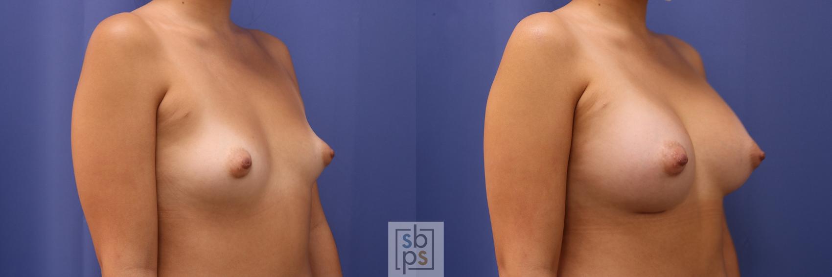Before & After Breast Augmentation Case 440 Right Oblique View in Torrance & Los Angeles, CA, CA