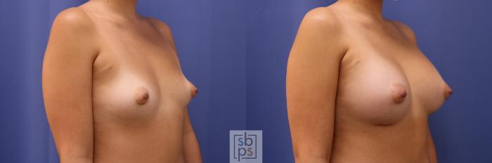 Before & After Breast Augmentation Case 440 Right Oblique View in Torrance, CA