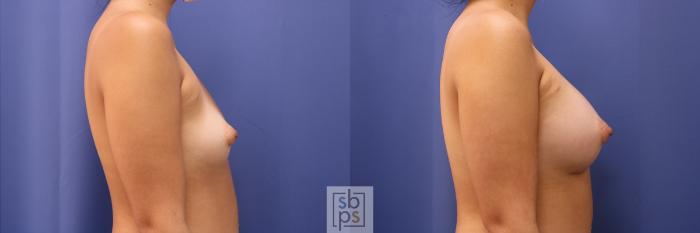 Before & After Breast Augmentation Case 440 Right Side View in Torrance, CA