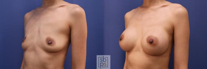 Before & After Breast Augmentation Case 441 Left Oblique View in Torrance, CA