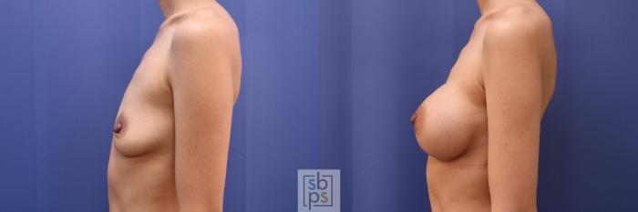 Before & After Breast Augmentation Case 441 Left Side View in Torrance, CA