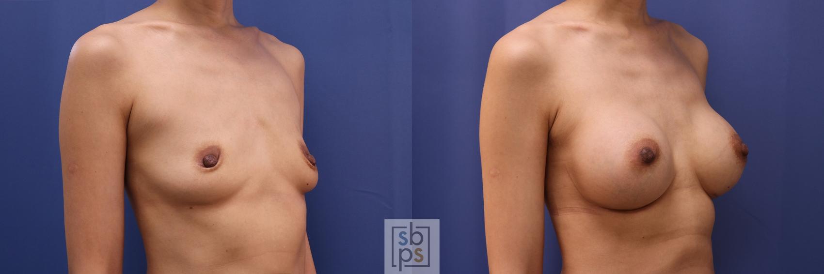 Before & After Breast Augmentation Case 441 Right Oblique View in Torrance & Los Angeles, CA, CA
