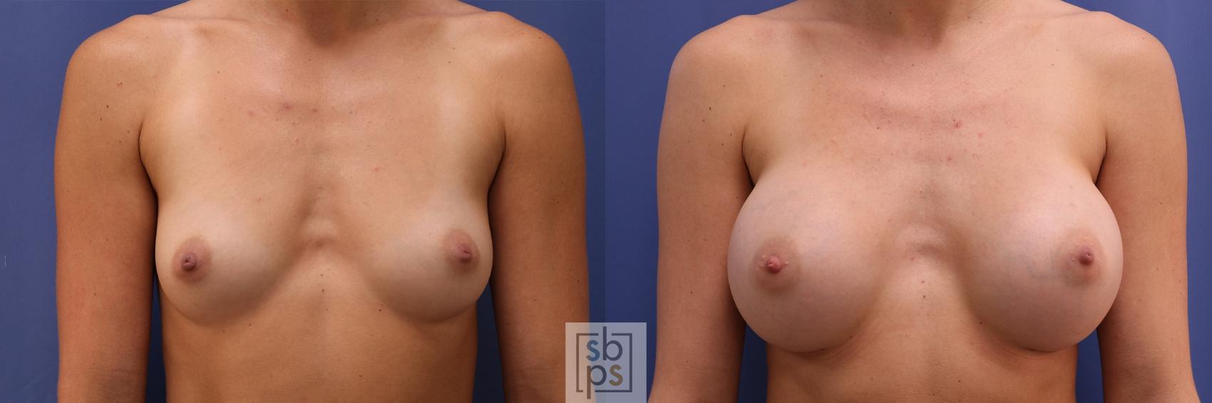Before & After Breast Augmentation Case 446 Front View in Torrance, CA