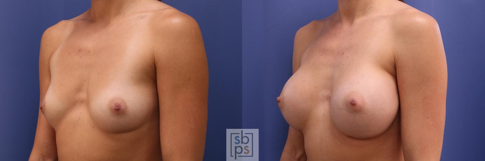 Before & After Breast Augmentation Case 446 Left Oblique View in Torrance & Los Angeles, CA, CA
