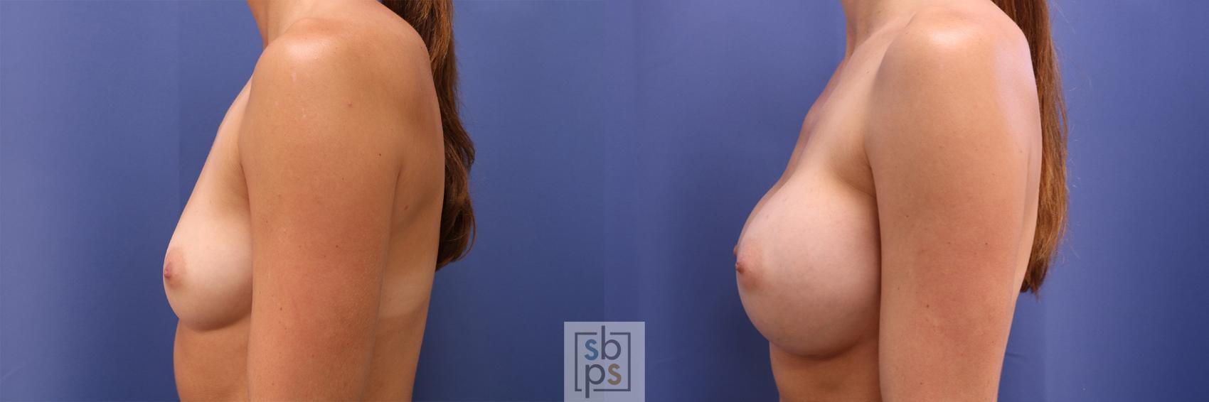 Before & After Breast Augmentation Case 446 Left Side View in Torrance & Los Angeles, CA, CA