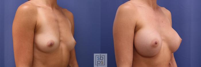 Before & After Breast Augmentation Case 446 Right Oblique View in Torrance, CA