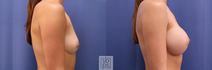 Before & After Breast Augmentation Case 446 Right Side View in Torrance, CA