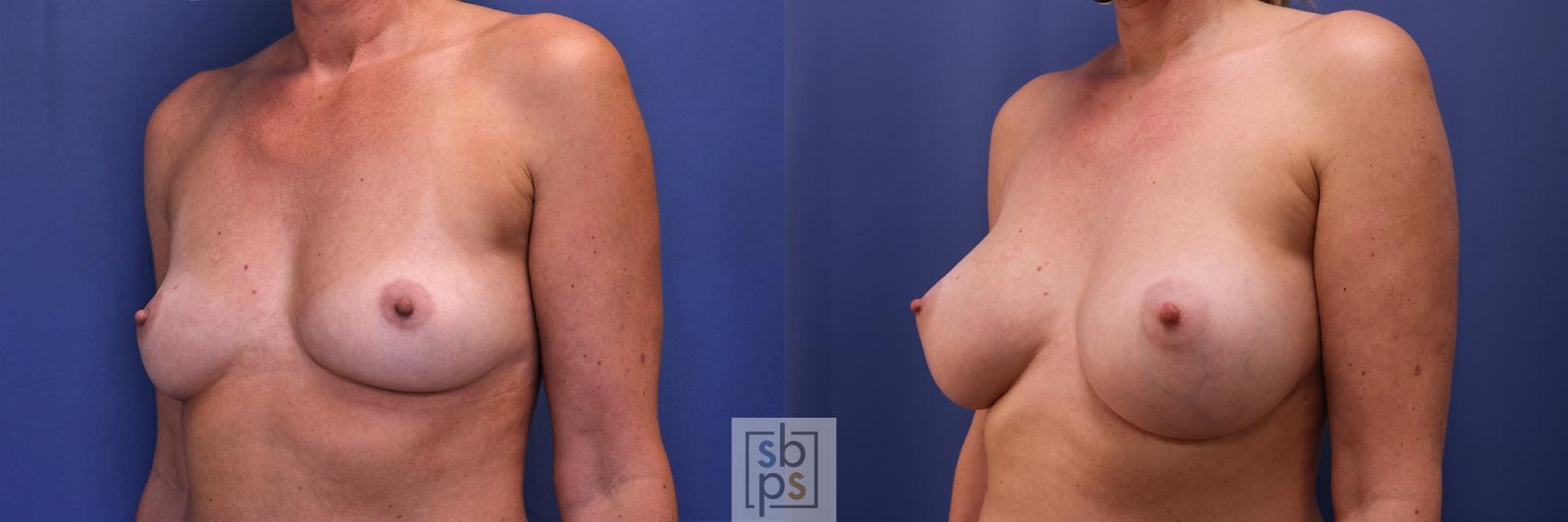 Before & After Breast Augmentation Case 448 Left Oblique View in Torrance & Los Angeles, CA, CA