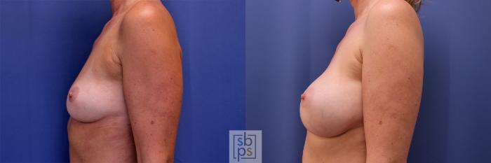 Before & After Breast Augmentation Case 448 Left Side View in Torrance, CA