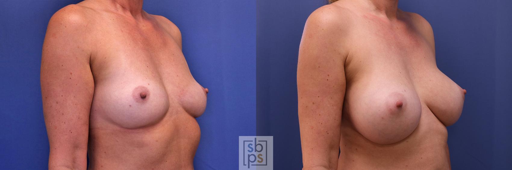 Before & After Breast Augmentation Case 448 Right Oblique View in Torrance & Los Angeles, CA, CA