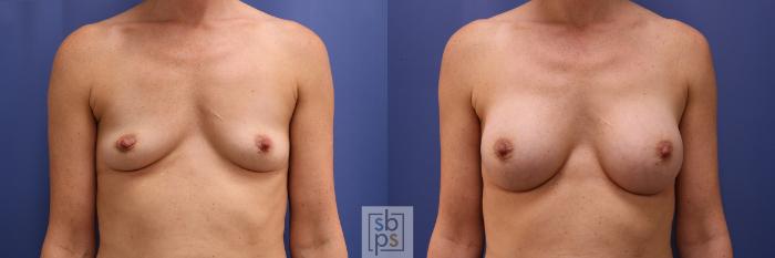 Before & After Breast Augmentation Case 449 Front View in Torrance, CA